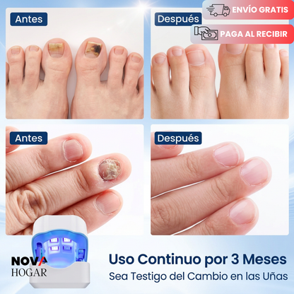 FungusPulse™ Dispositivo Láser Profesional Antihongos