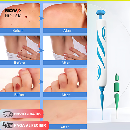 ClearTag™  kit Removedor de Verrugas